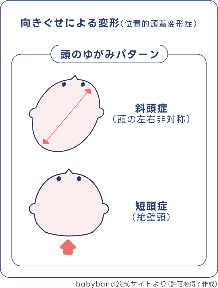Babyband様提供「むきぐせによる頭の歪みのパターン説明画像」