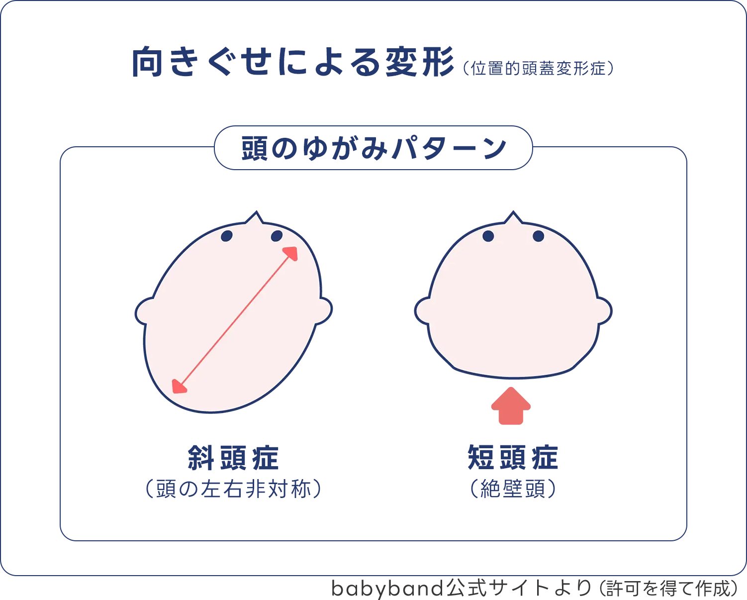Babyband様提供「むきぐせによる頭の歪みのパターン説明画像」