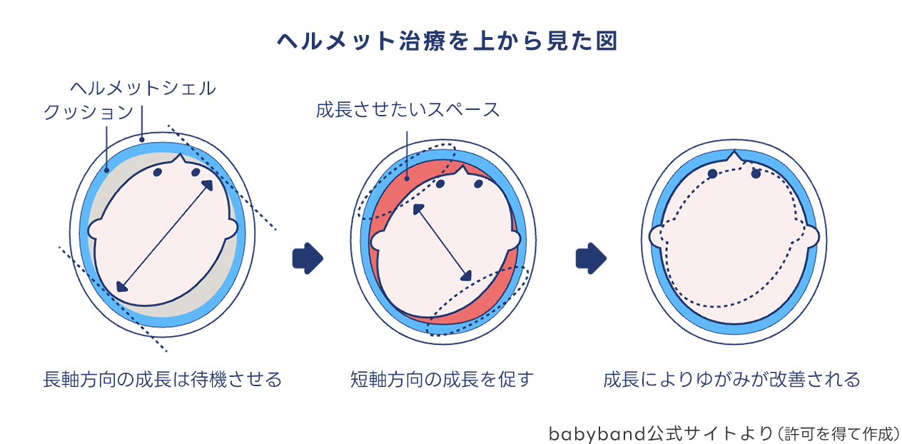 Babyband様提供「メルメット治療を上から見た図