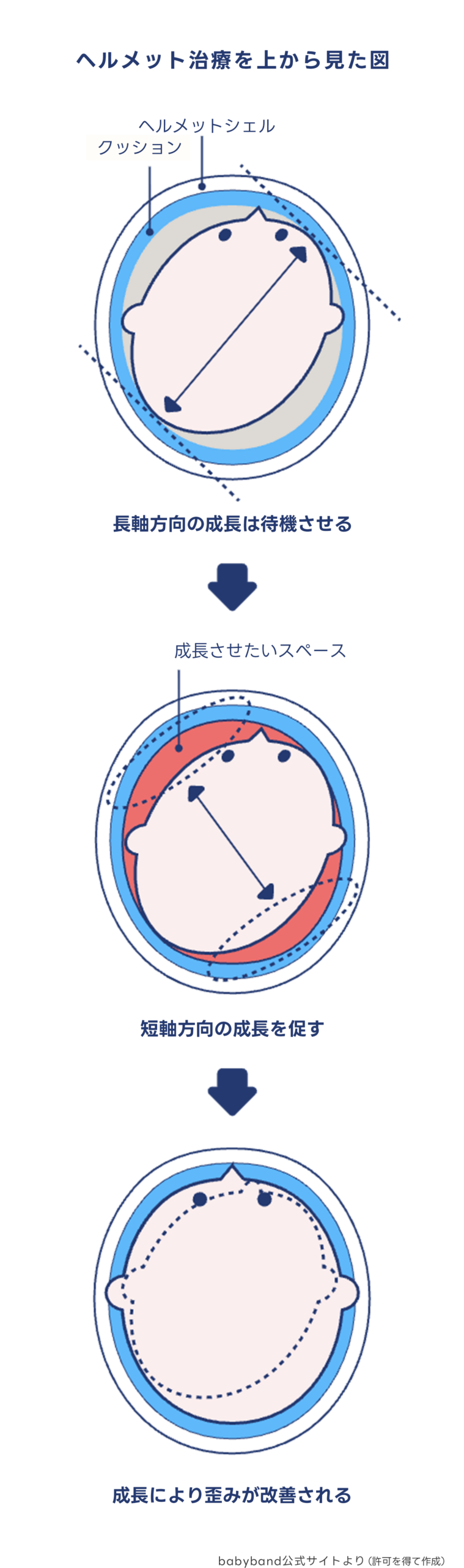 Babyband様提供「メルメット治療を上から見た図